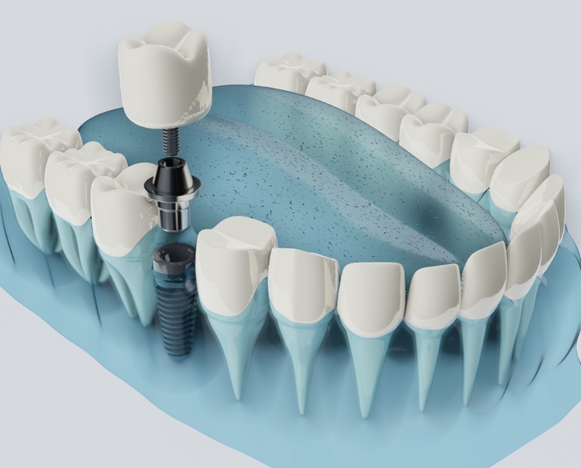 Les particularités des implants dentaires